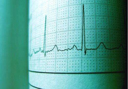ECG