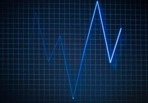 ECG