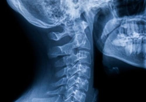 X-ray of neck