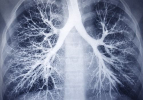 X-ray of chest