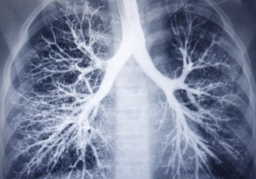 Chest x-ray