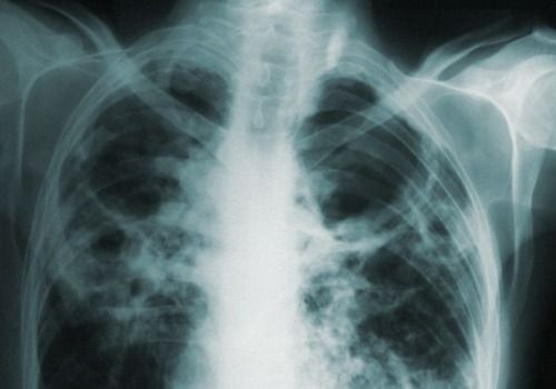 Pulmonary tuberculosis