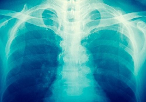 X-ray of chest