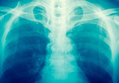 X-ray of chest