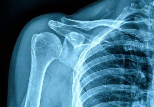 X-ray of shoulder