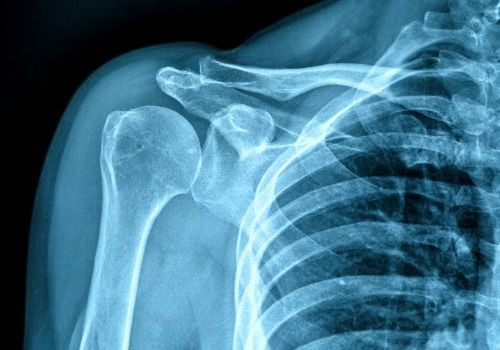 X-ray of shoulder