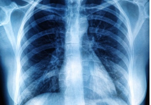 X-ray of chest